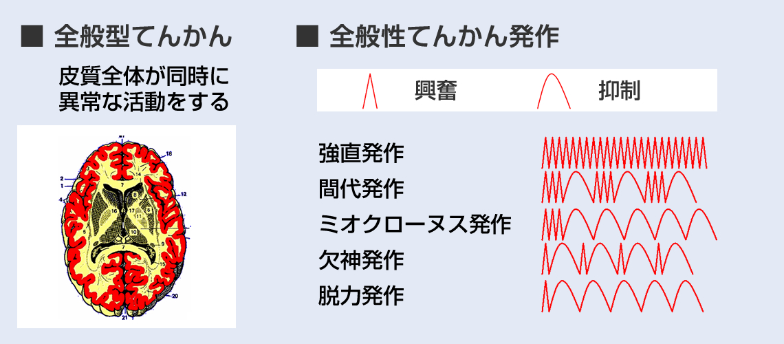 全般型てんかんについて