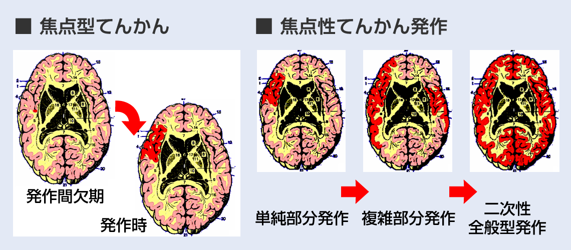 てんかん 発作 症状